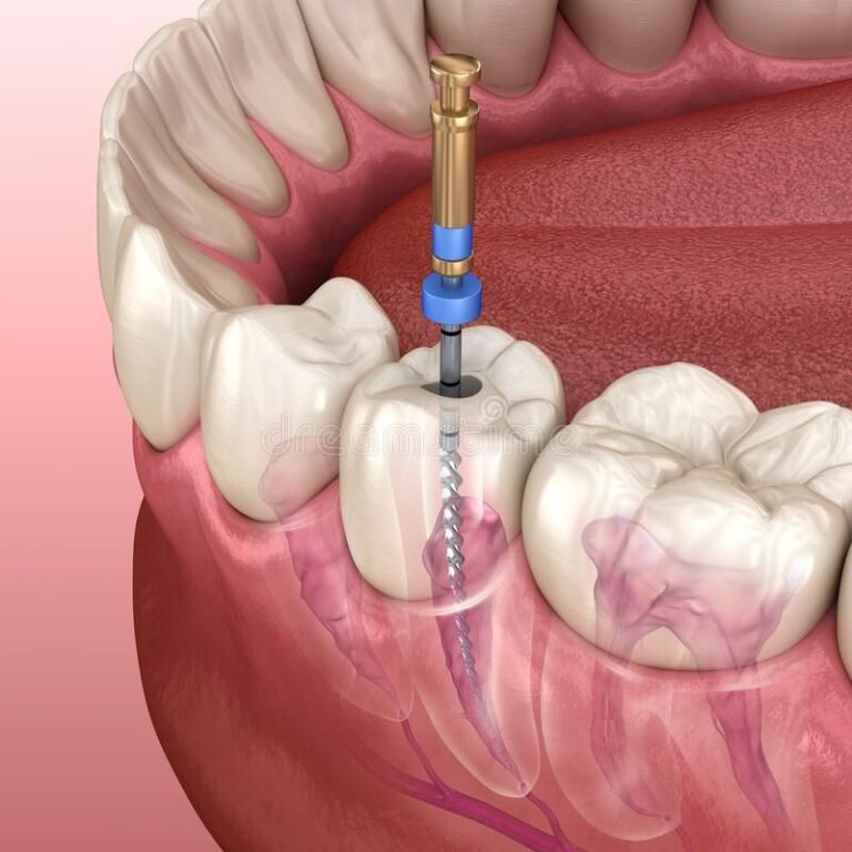 Endodontic Root Canal Treatment Process_ Medically Accurate Tooth Illustration Stock Illustration - Illustration of canal, cementum_ 180481735