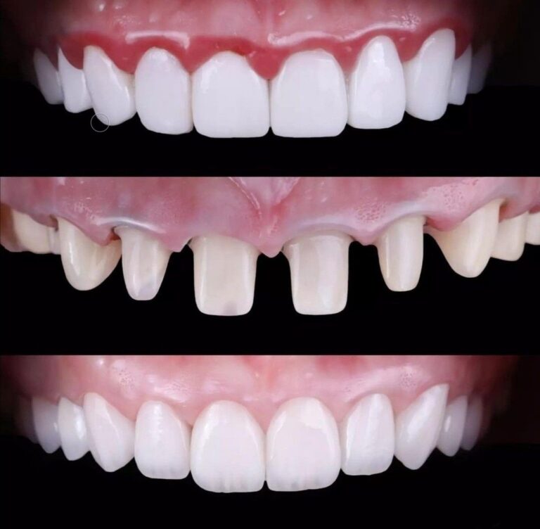 Teeth crowns before and after veneers whitening