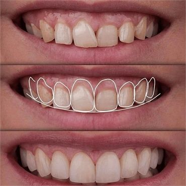 What is the difference between gingivectomy and gingivoplasty_