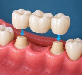 FIXED PROSTHESIS